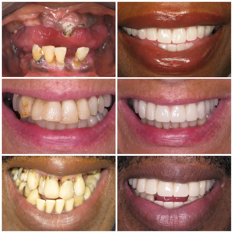 TeethNow Dental Implants New Jersey